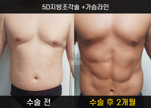 4D 지방흡입 vs 5D 지방조각술 – 어떤 지방흡입이 나에게 맞을까?