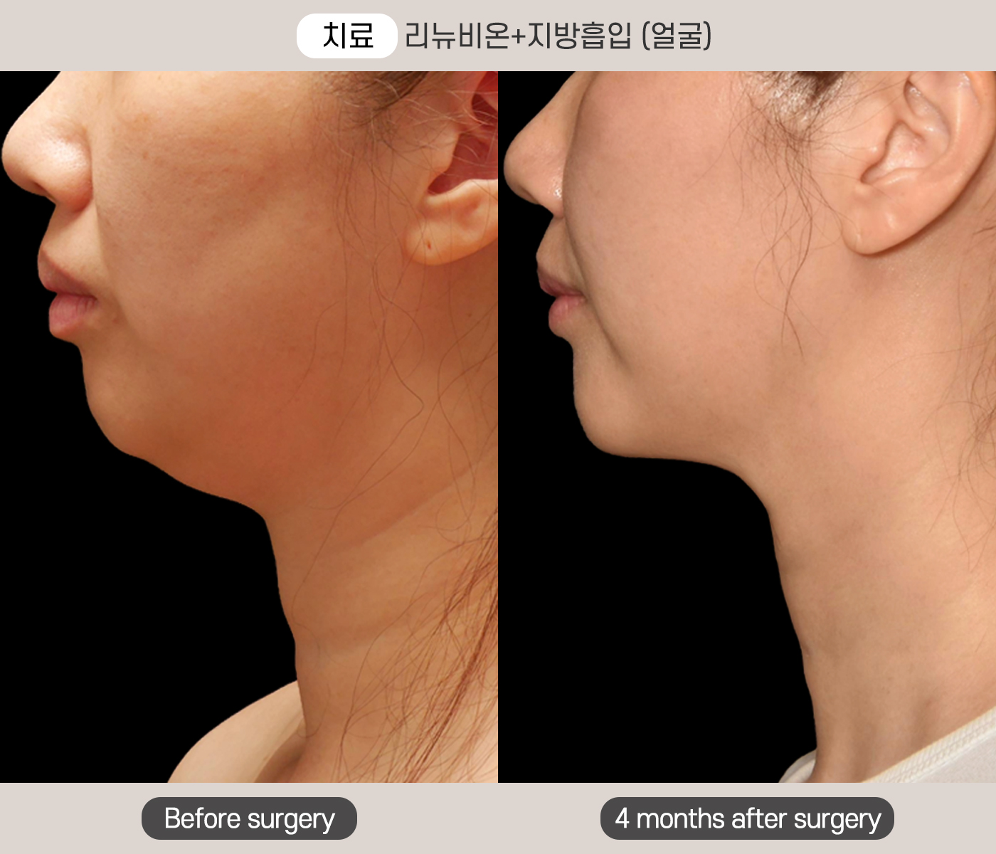 턱 라인 리뉴비온 지방흡입 시술