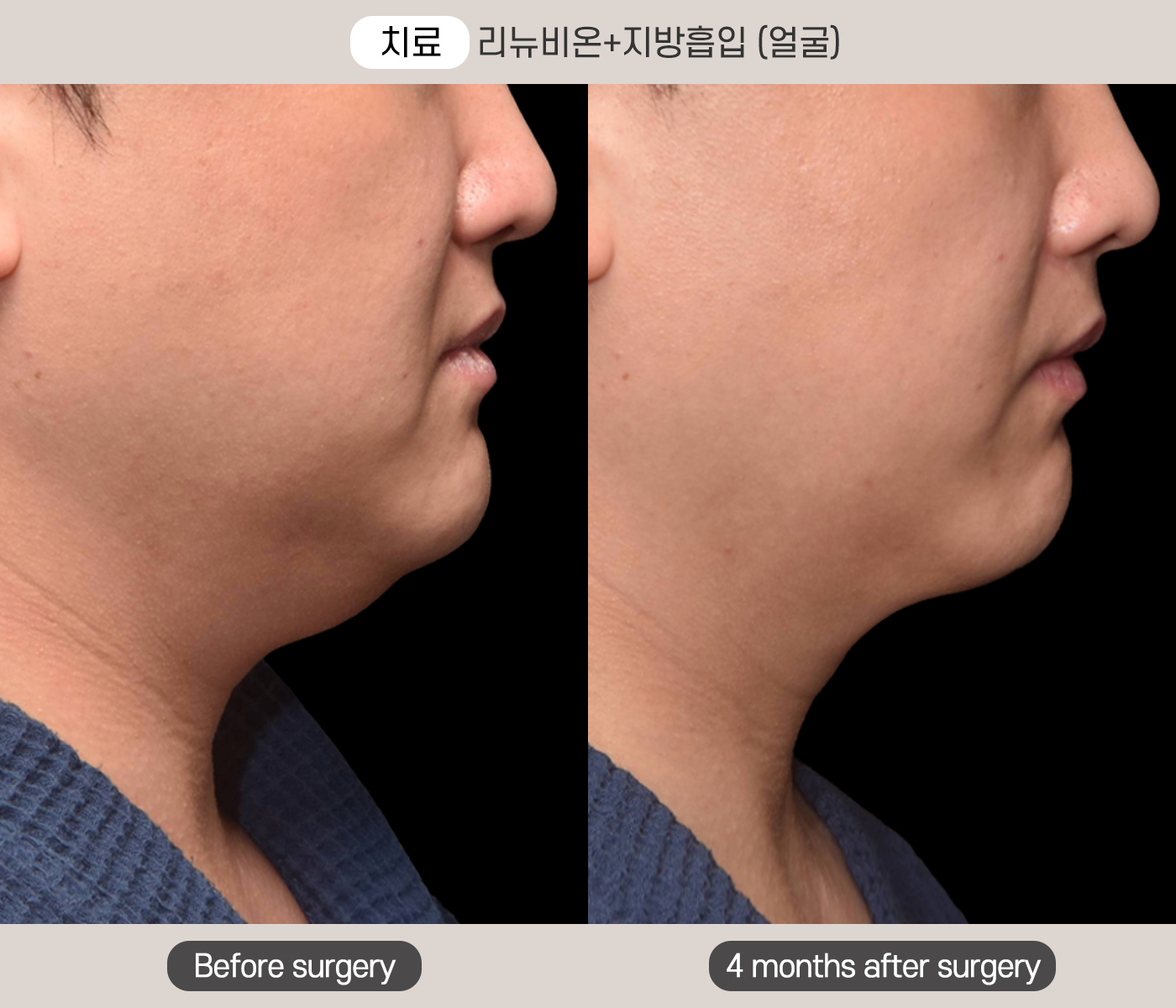 턱 라인 리뉴비온 지방흡입 시술