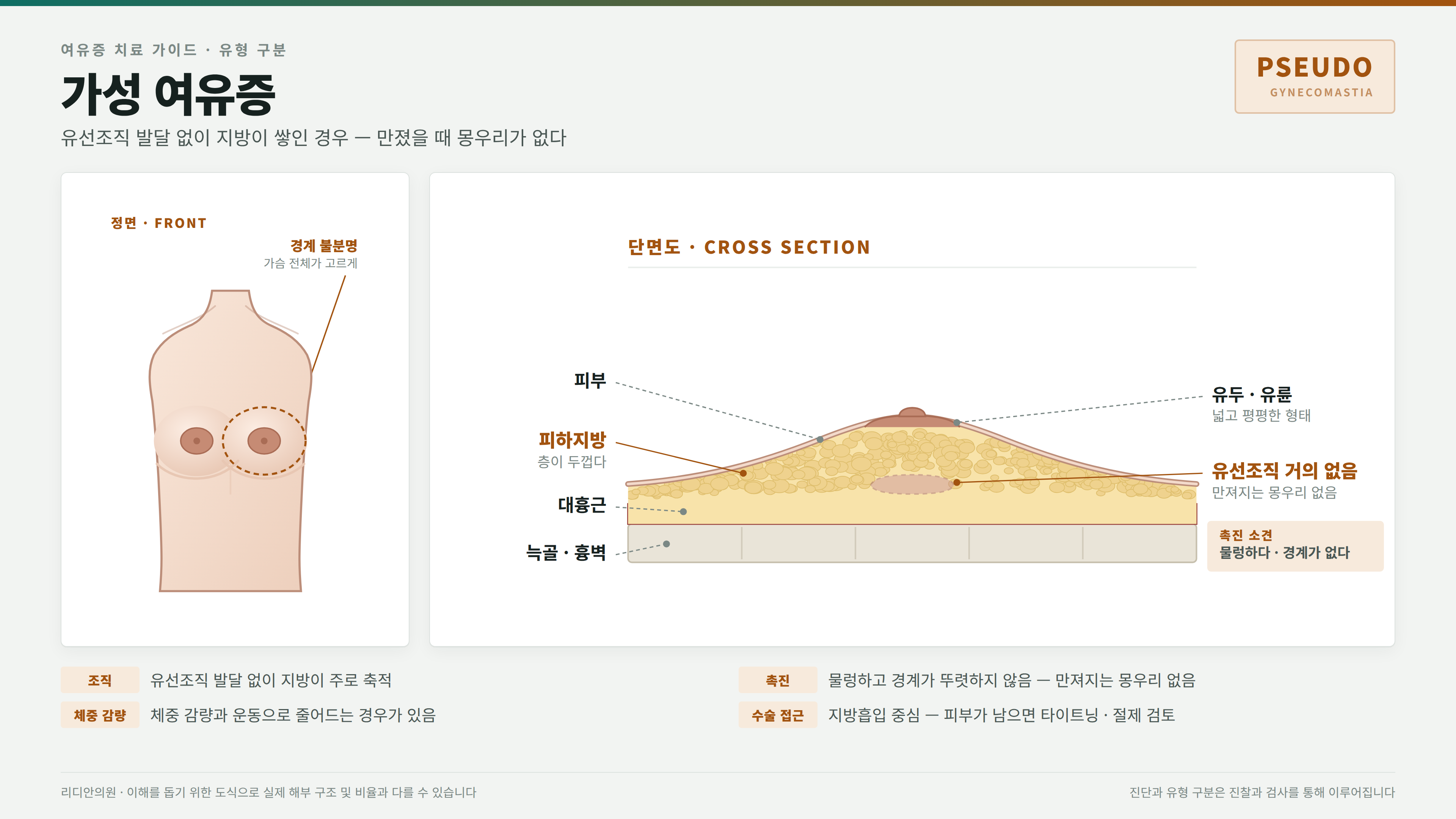 가성 여유증 
